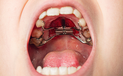 Why? How? When? to use a rapid palatal expander (RPE)