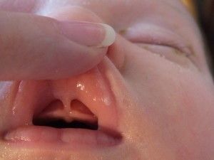 Frenectomy3.jpg