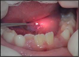 Frenectomy6.jpg