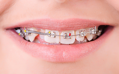 Eating with Braces