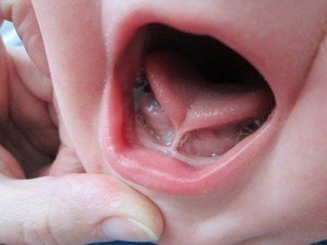 Frenectomy2.jpg