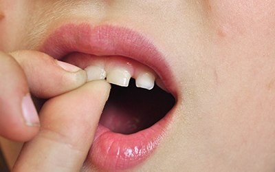 When Do Baby Teeth Fall Out? A Parent's Guide