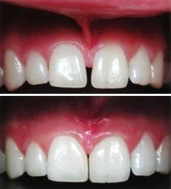 Frenectomy5.jpg