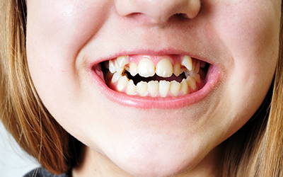 How to Tell if Your Child Needs Braces