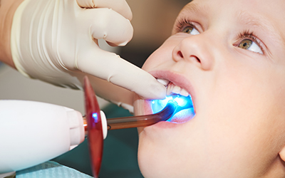 The Ultimate Guide to Dental Sealants for Kids