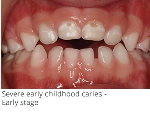 https://goldenkidsdentalandorthodontics.com/wp-content/uploads//2019/04/pediatricdecay6.jpg