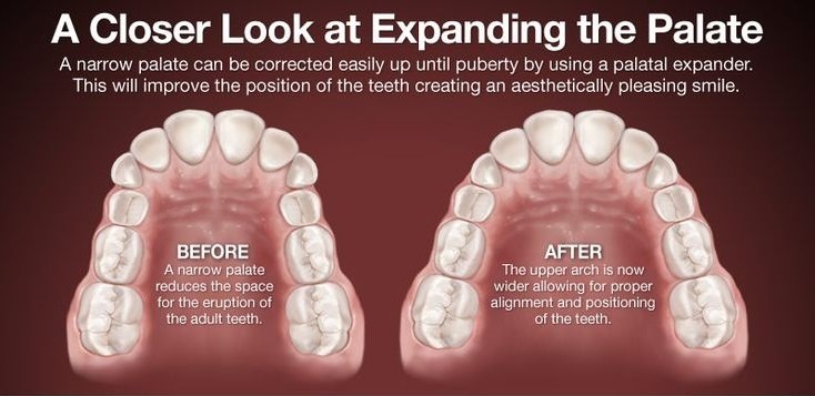 The Role of the Palatal Expander in Pediatric Orthodontistry