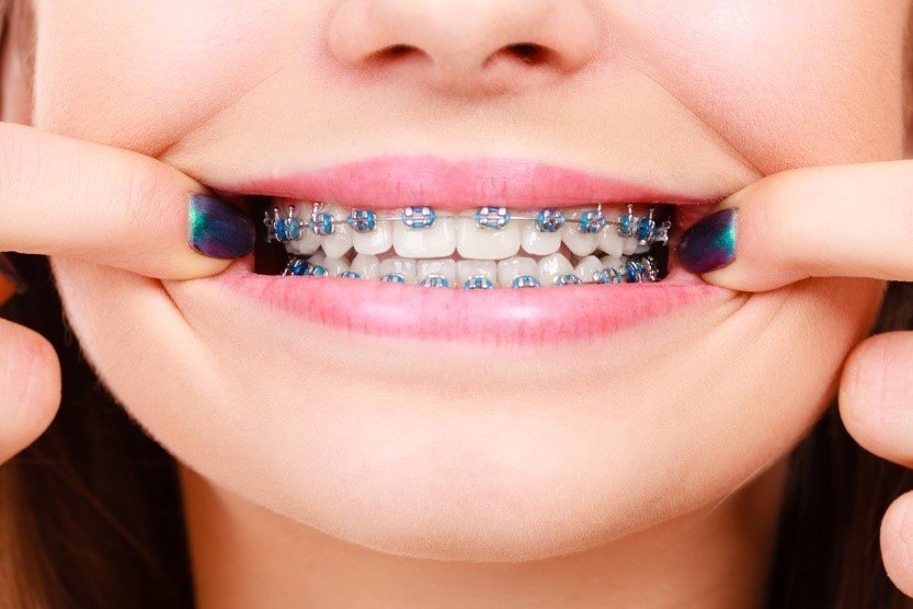 metalbraces